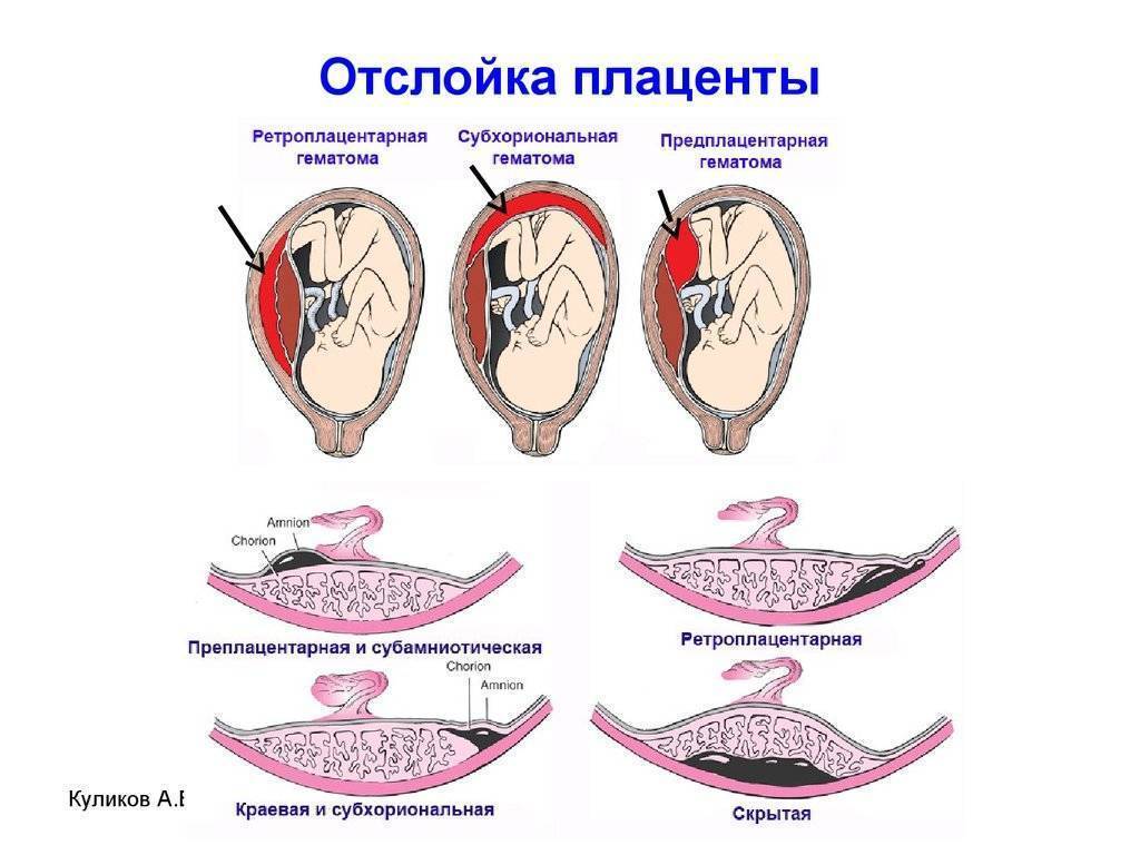 Процесс образования новых родов. Отслоение плаценты при беременности 2 триместр. Диагностические критерии предлежание плаценты. Ранний симптом отслойки плаценты. Беременность отслойка плаценты на ранних сроках беременности.