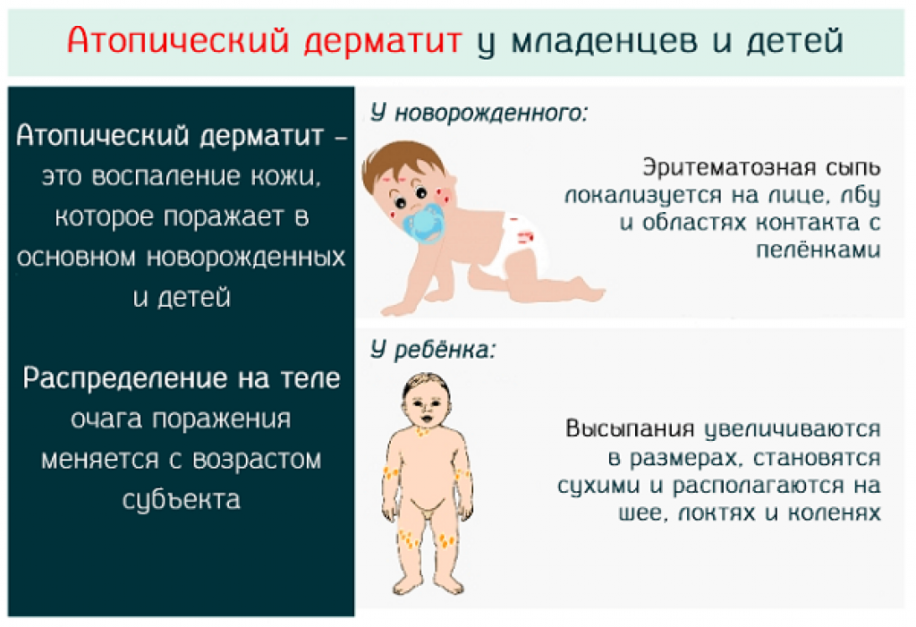 Как распознать аллергию у малыша до года: Неожиданные симптомы и решения