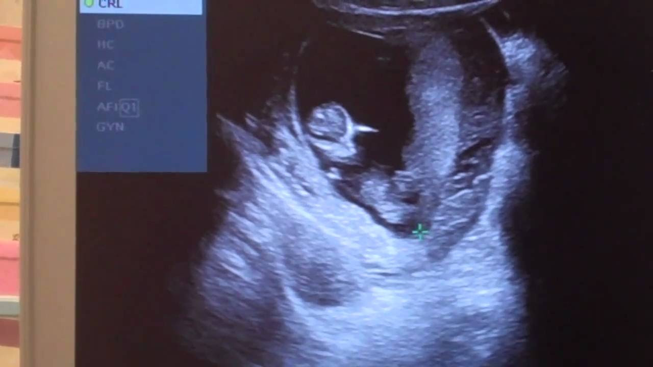 11 неделя 24 года. 11 Недель беременности. 11 Недель беременности фото. 11 Недель беременности видео. Фото скрина беременности 11 недель.