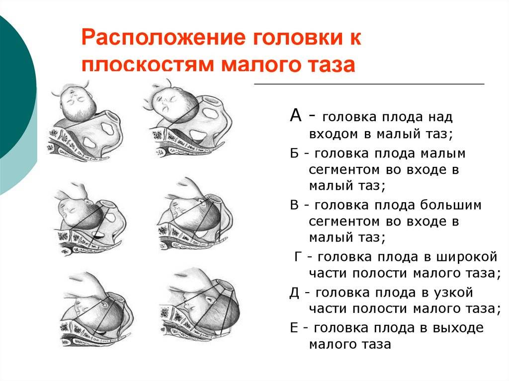 Как проходят роды при разных видах предлежания: Секреты биомеханизма