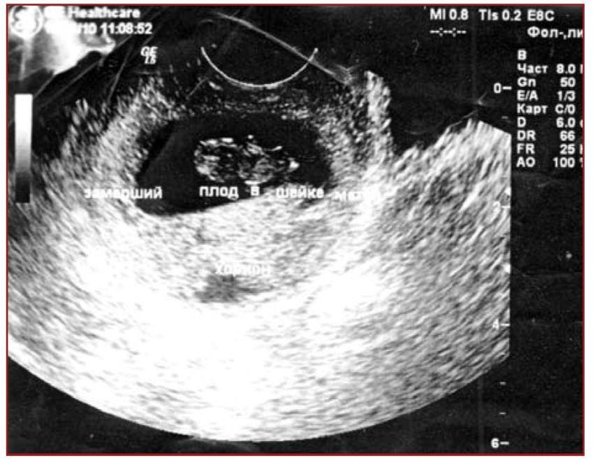 Замершая беременность на раннем. Шеечная внематочная беременность УЗИ. Шеечная беременность УЗИ. Замершая беременность УЗИ. Замершая внематочная беременность УЗИ.