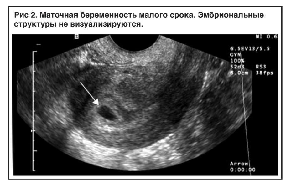 Полип после медикаментозного прерывания. Остатки плодного яйца УЗИ. Маточная беременность раннего срока. Маточная беременность УЗИ. Неразвивающаяся беременность УЗИ.