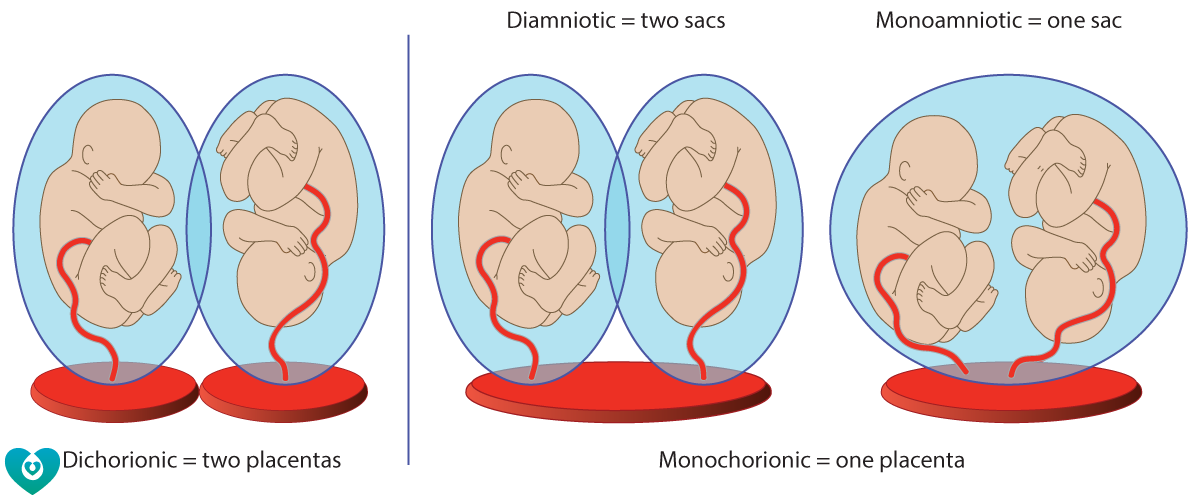 Twin что значит. Монохориальная моноамниотическая многоплодная беременность. Многоплодная беременность разнояйцевые Близнецы. Дизиготная многоплодная беременность. Многоплодная беременность дихориальная диамниотическая.