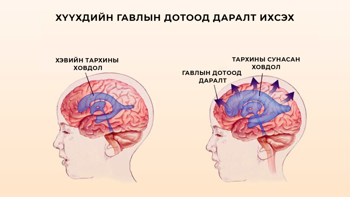 Ликворные изменения мозга