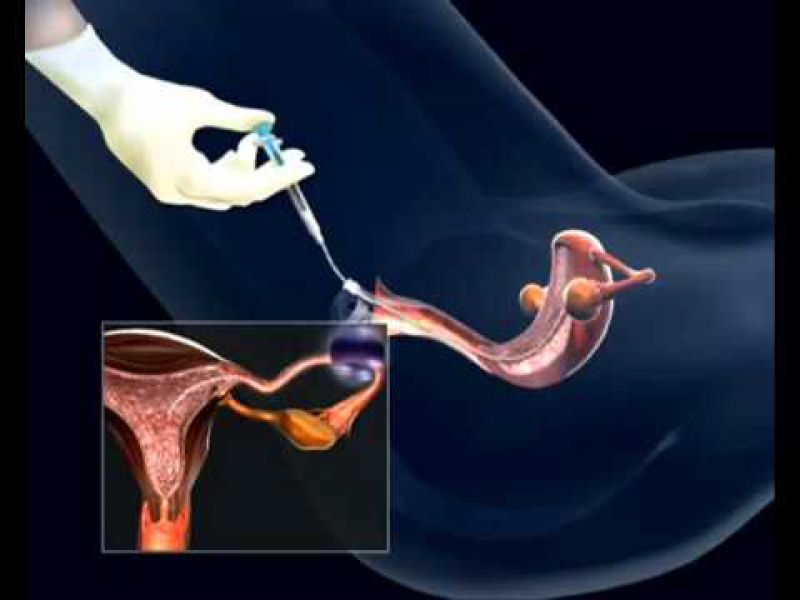Как работает внутриматочная инсеминация: Секреты успешного зачатия
