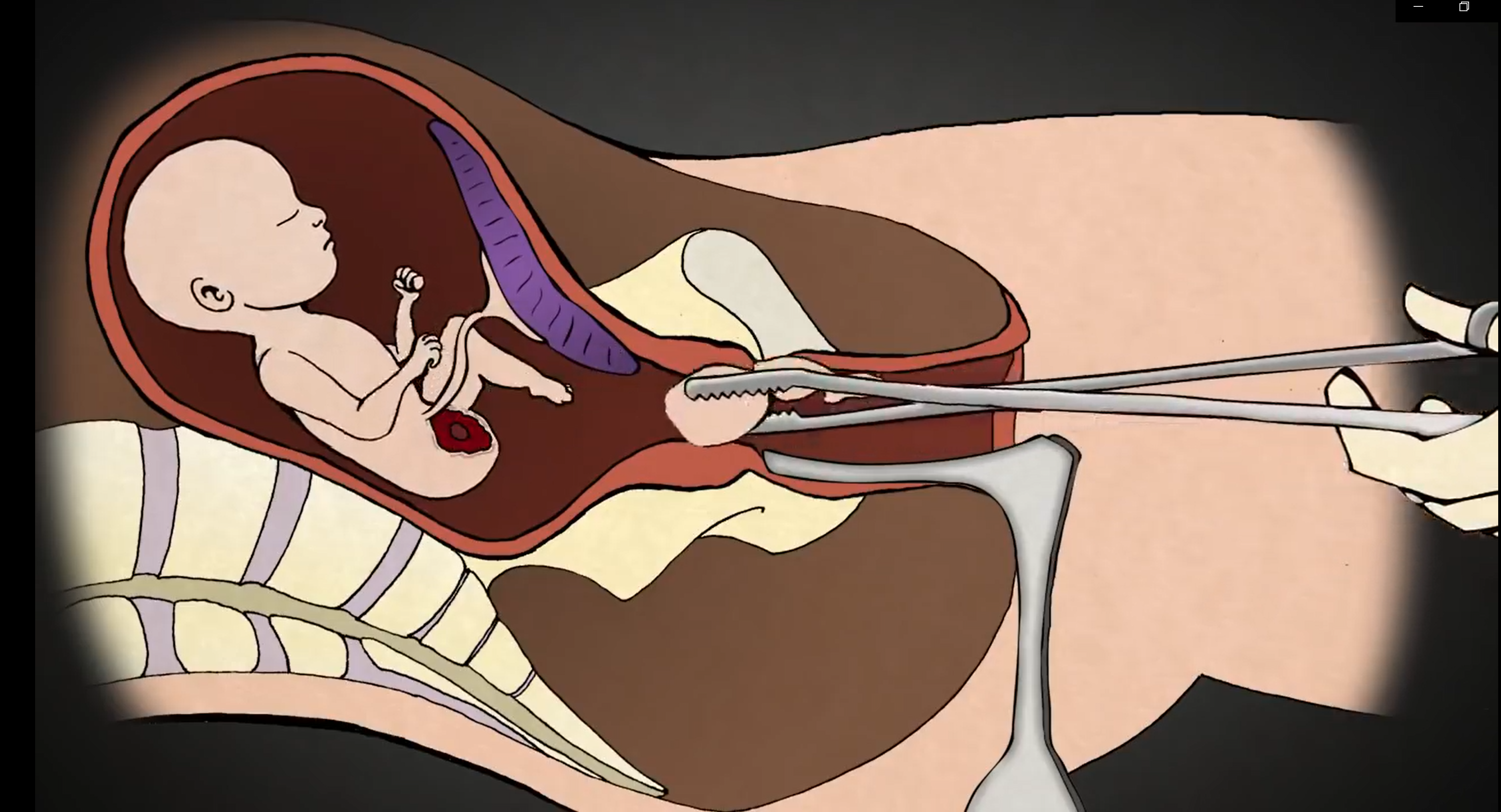 Хирургический аборт на поздних сроках. Инструментальный аборт. Искусственное прерывание родов. После прокола пузыря начинаются роды
