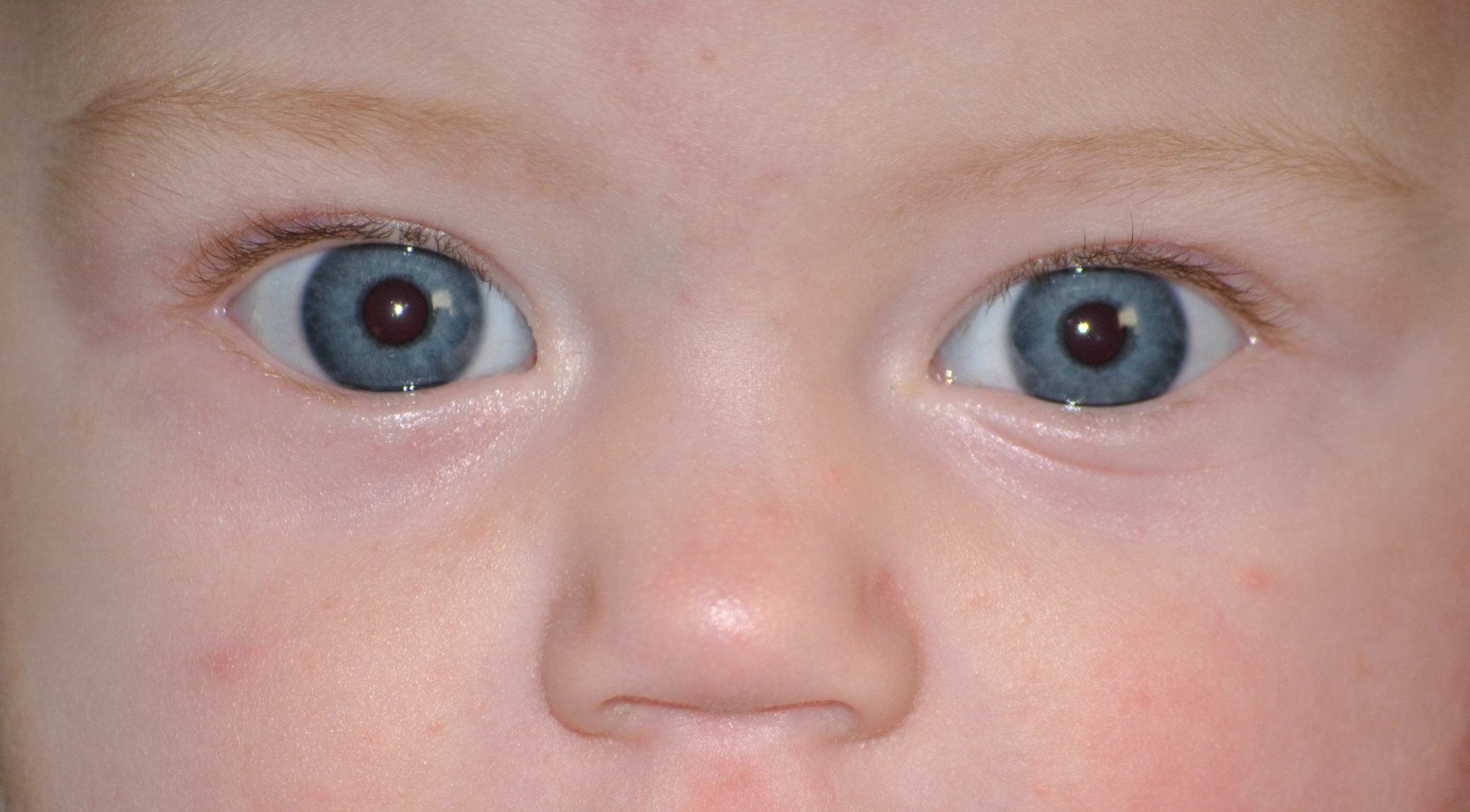 Почему у ребенка голубые глаза. Непроходимость слезного канала дакриоцистит. Глаза новорожденного. Дакриоцистит новорожденных.