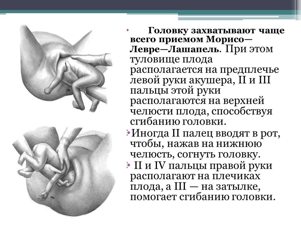 Как обеспечить безопасные роды при затылочном предлежании плода: Ключ к успешному родоразрешению