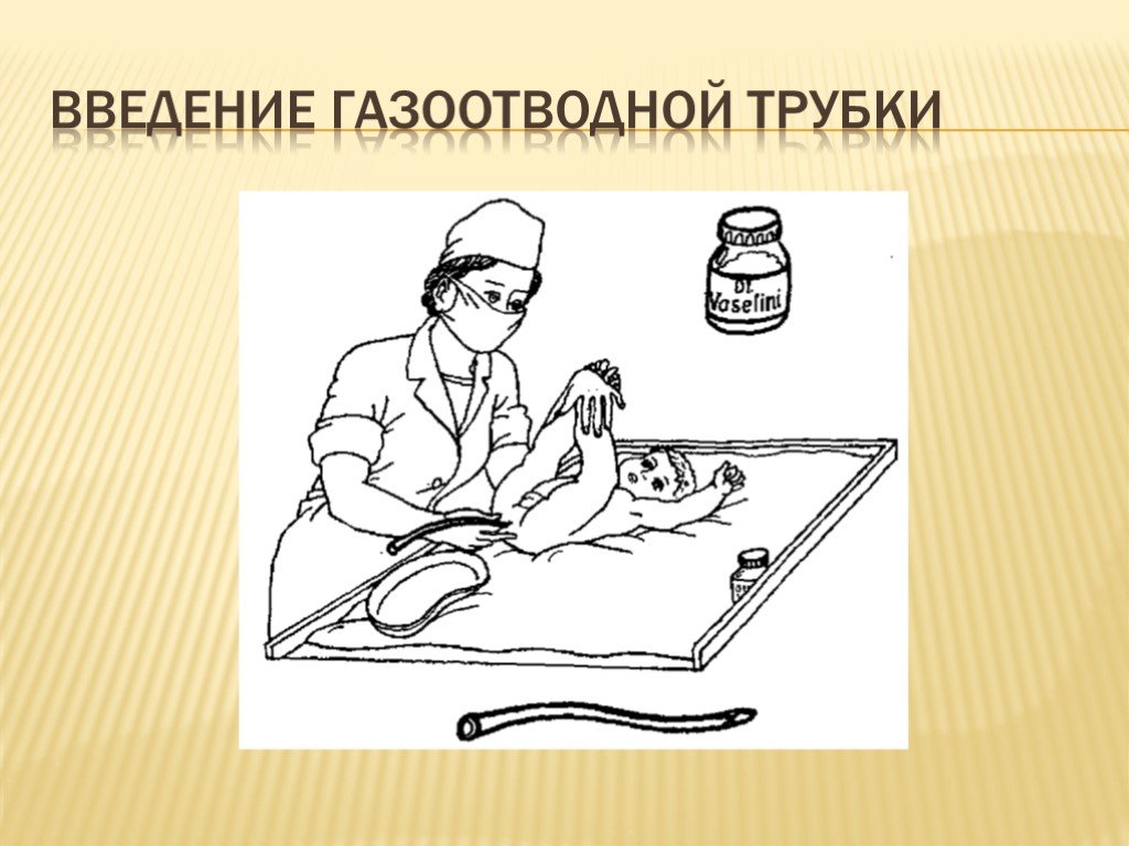 Как ставить клизму. Введение газоотводной трубки. Техника постановки газоотводной трубки.