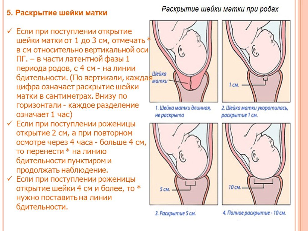 Как понять, что скоро роды: Раскрытие шейки матки на 2 см