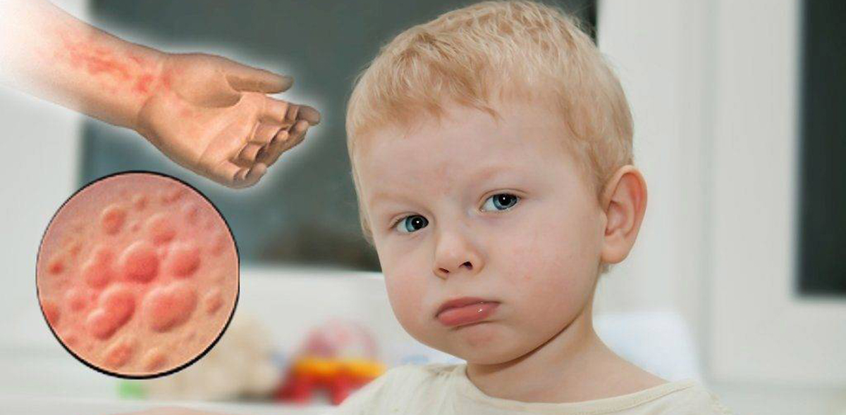 Аллергия на антибиотики у детей: как распознать и что делать