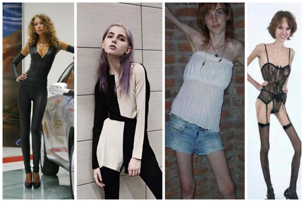 Болезненно худая. Фото моделей анорексичек. Болезненно худая девушка. Модельная худоба. Одежда для анорексичек.
