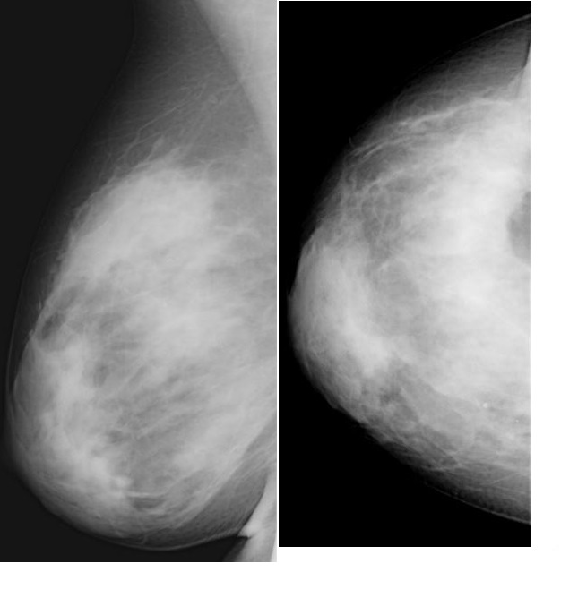 Маммография старый. ЗНО молочной железы на маммографии. Липогранулема молочной железы маммография.