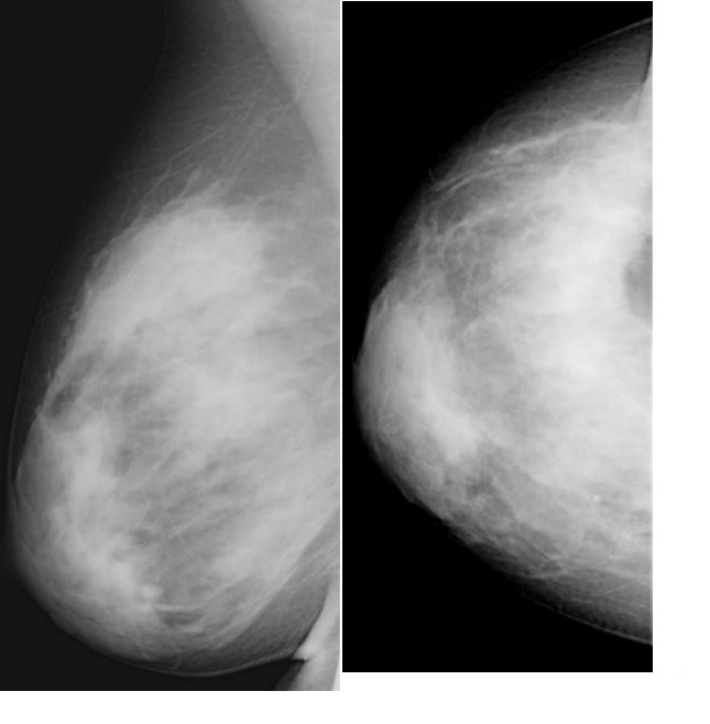 Дольки молочной железы фото. Маммография кальцинаты доброкачественные. Липогранулема молочной железы на маммографии.