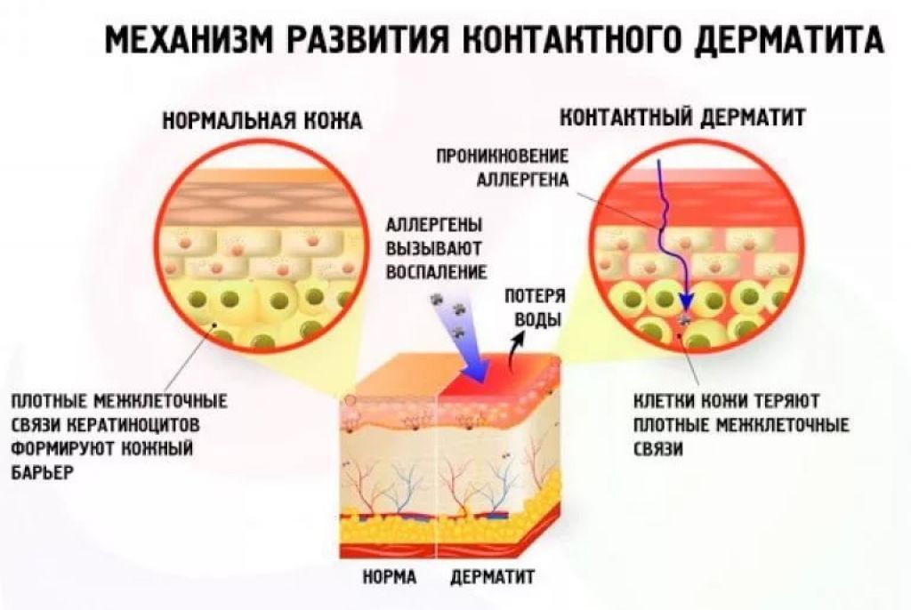 Как лечить атопический дерматит летом: Солнечные секреты здоровой кожи