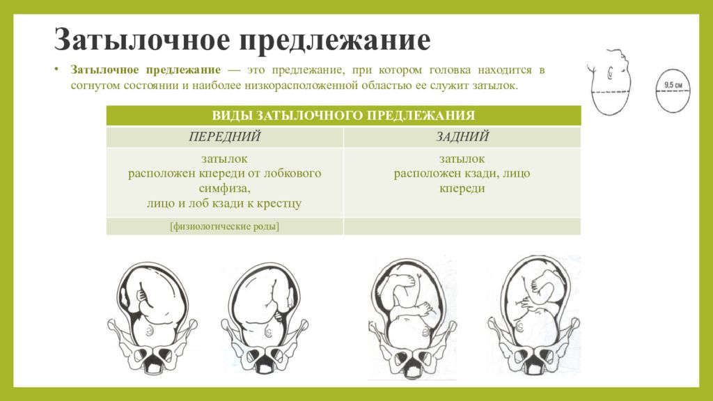 Как обеспечить безопасные роды при затылочном предлежании плода: Ключ к успешному родоразрешению