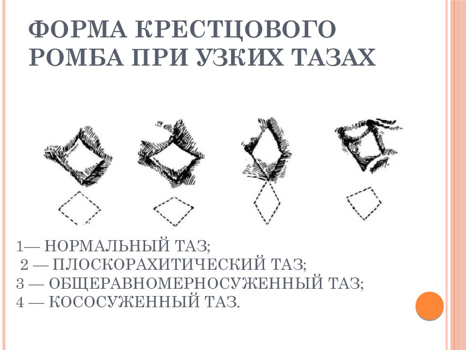 Как оценить таз беременной: Ромб Михаэлиса раскрывает секреты акушерства