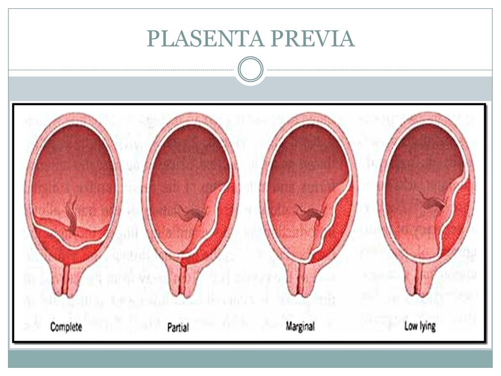 Низкая плацентация фото