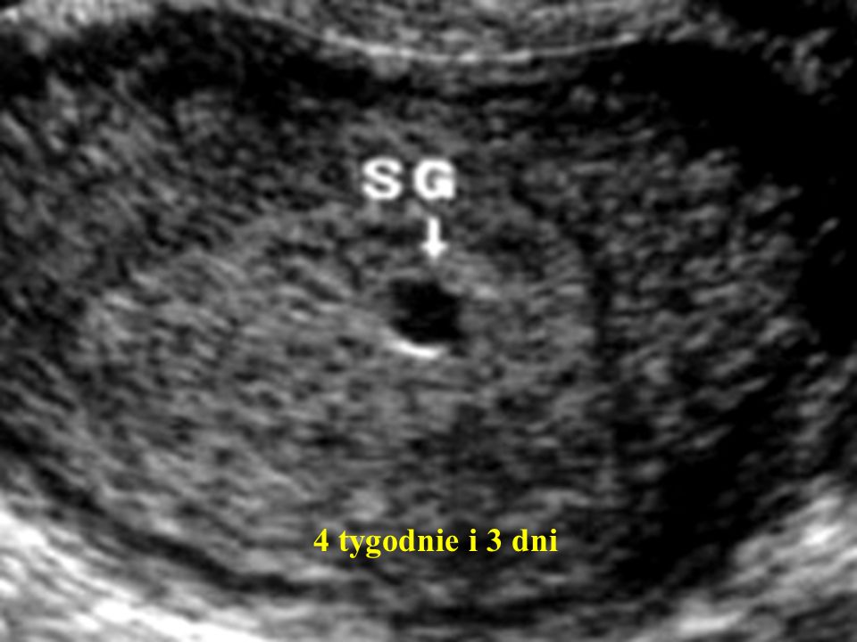 Эндометрий при переносе эмбриона. УЗИ беременность 2 плодных яйца. Плодное яйцо на УЗИ 4 недели.