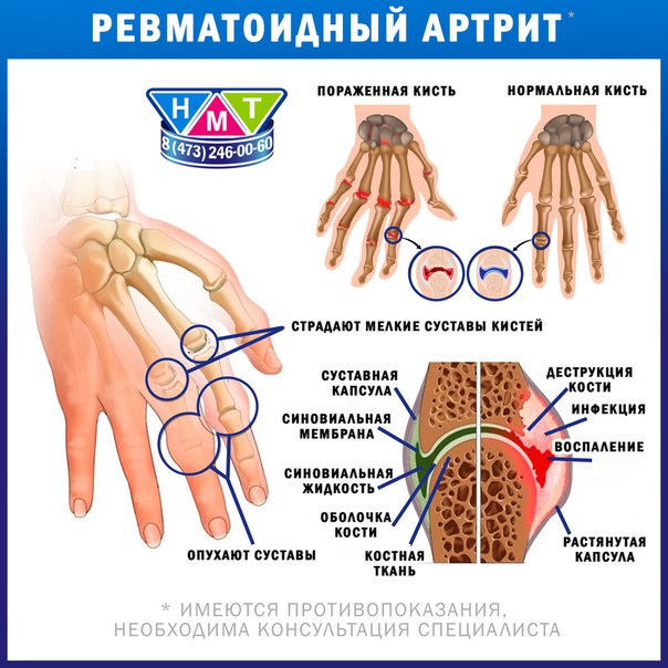 Ревматоидный артрит форум. ВСД И ревматоидный артрит. При ревматоидном артрите определяется тест хвата кистей. Ревматоидный артрит на пальце перчатки одеть можно. Ревматоидный артрит у котов.