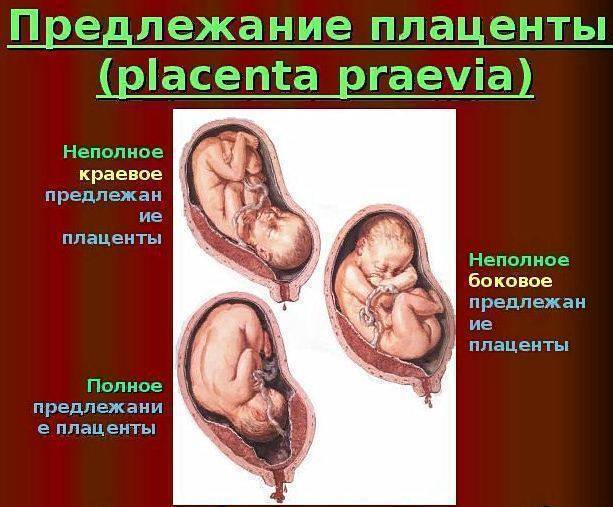 22 неделе плацента. Предлежание плаценты. Краевое предлежание плаценты. Предлежание плаценты при беременности. Центральное боковое и краевое предлежание плаценты.