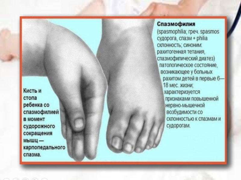 Рука нога когда у ребенка. Судороги при спазмофилии у детей. Характерный признак спазмофилии у детей. Спазмофилия причины судорог у детей. Судорожный симптом у детей.