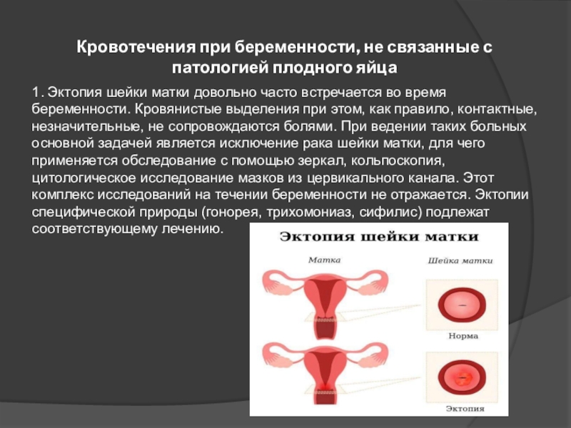 Маточное кровотечение при беременности. Кровотечение во время беременности. Кровотечения не связанные с патологией плодного яйца.
