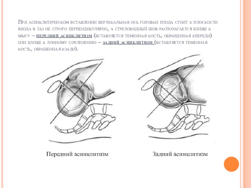 Вставление головки виды