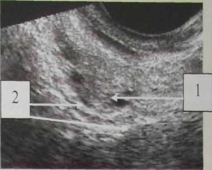 Подсаживали 2 эмбриона. Эмбрион в матке после переноса на УЗИ. УЗИ после переноса эмбрионов.