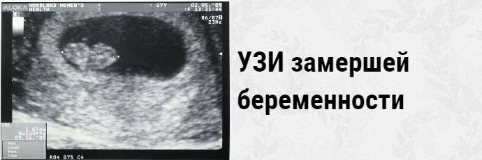 Беременность после замершей беременности отзывы. Замершая беременность 6-7 недель причины. Замершая беременность УЗИ. УЗИ замершая беременность 5 недель. УЗИ замершей беременности 7 недель.