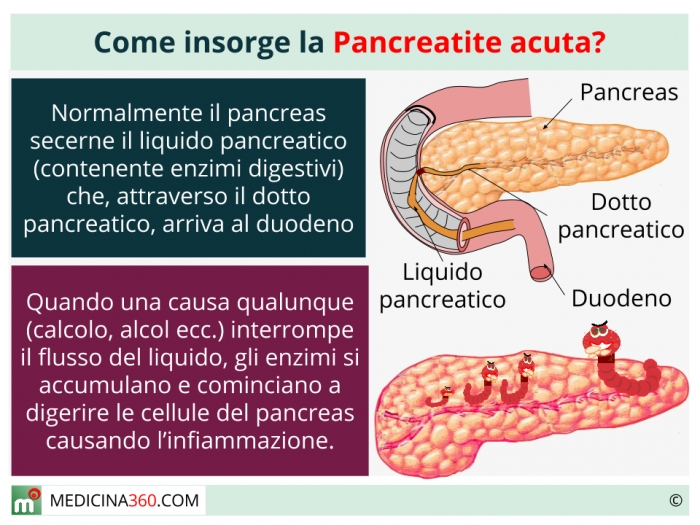 Панкреатит поджелудочной железы у женщин как лечить. Острый панкреатит поджелудочной железы. Острый идиопатический панкреатит. Патология поджелудочной железы панкреатит. Симптомы панкреатита поджелудочной железы.
