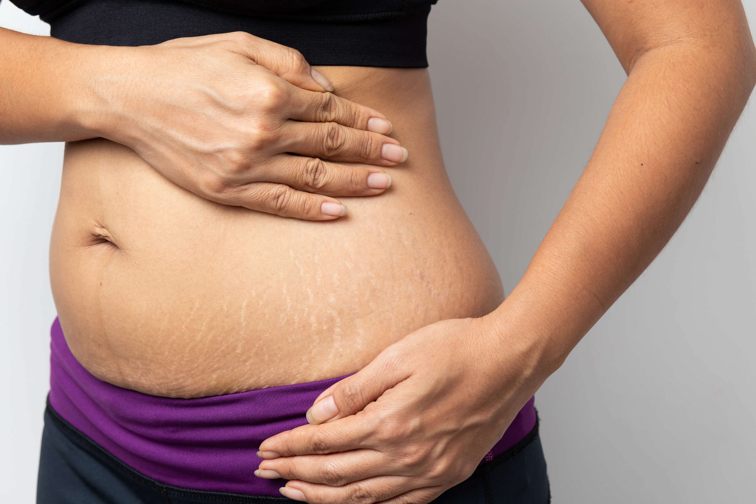 Как избавиться от растяжек при беременности: Секреты эффективного ухода за кожей живота