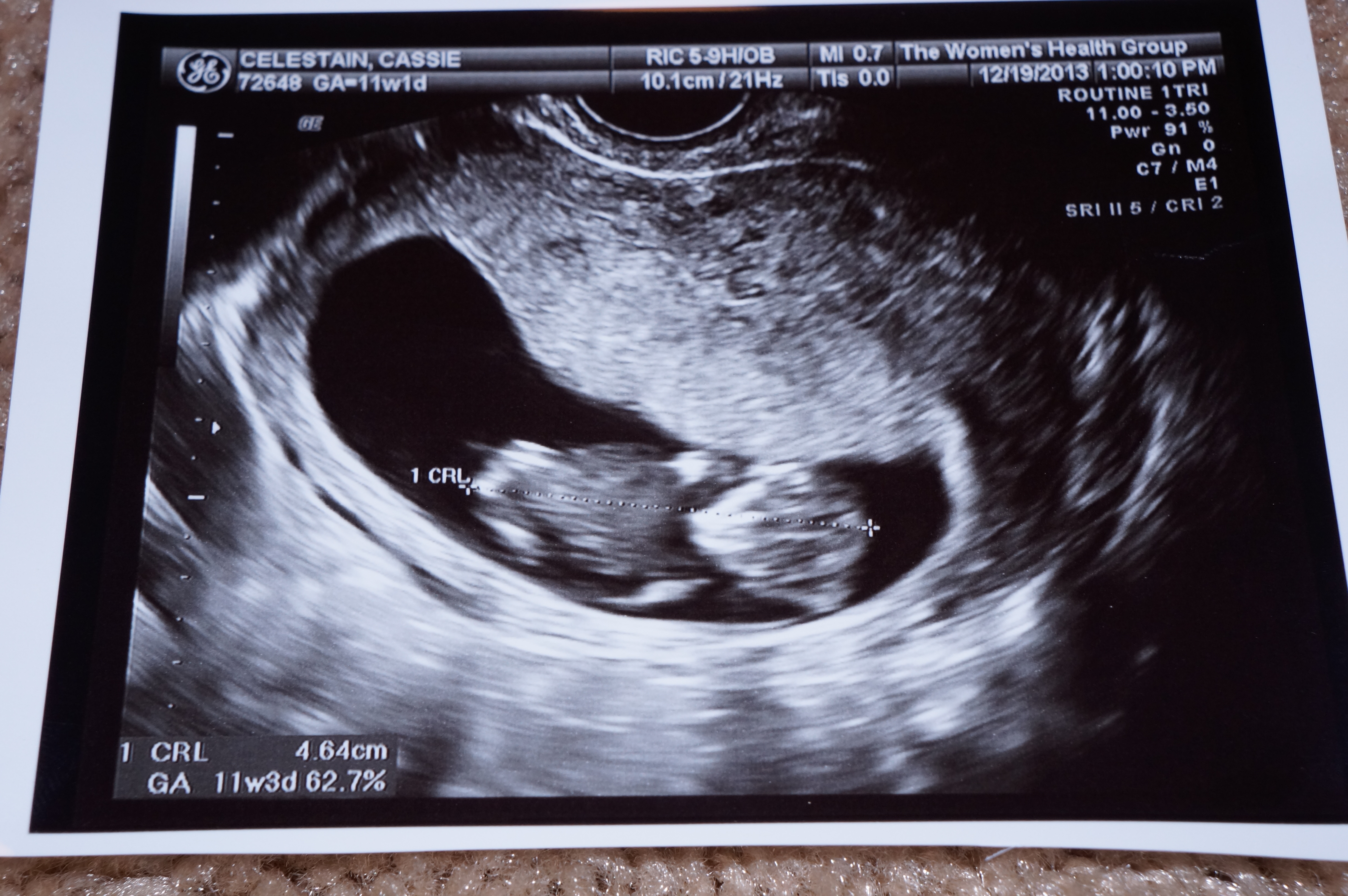 11 неделя 2024г. УЗИ 11 недель беременности. Фото малыша на 11 неделе беременности УЗИ. УЗИ 11-12 недель беременности пол ребенка. Плода 11 недель как выглядит УЗИ.