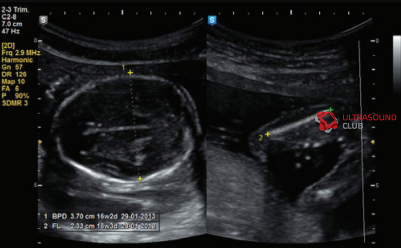 Длина бедренной. УЗИ измерения плода. Что такое БПР на УЗИ. Окружность живота плода УЗИ.