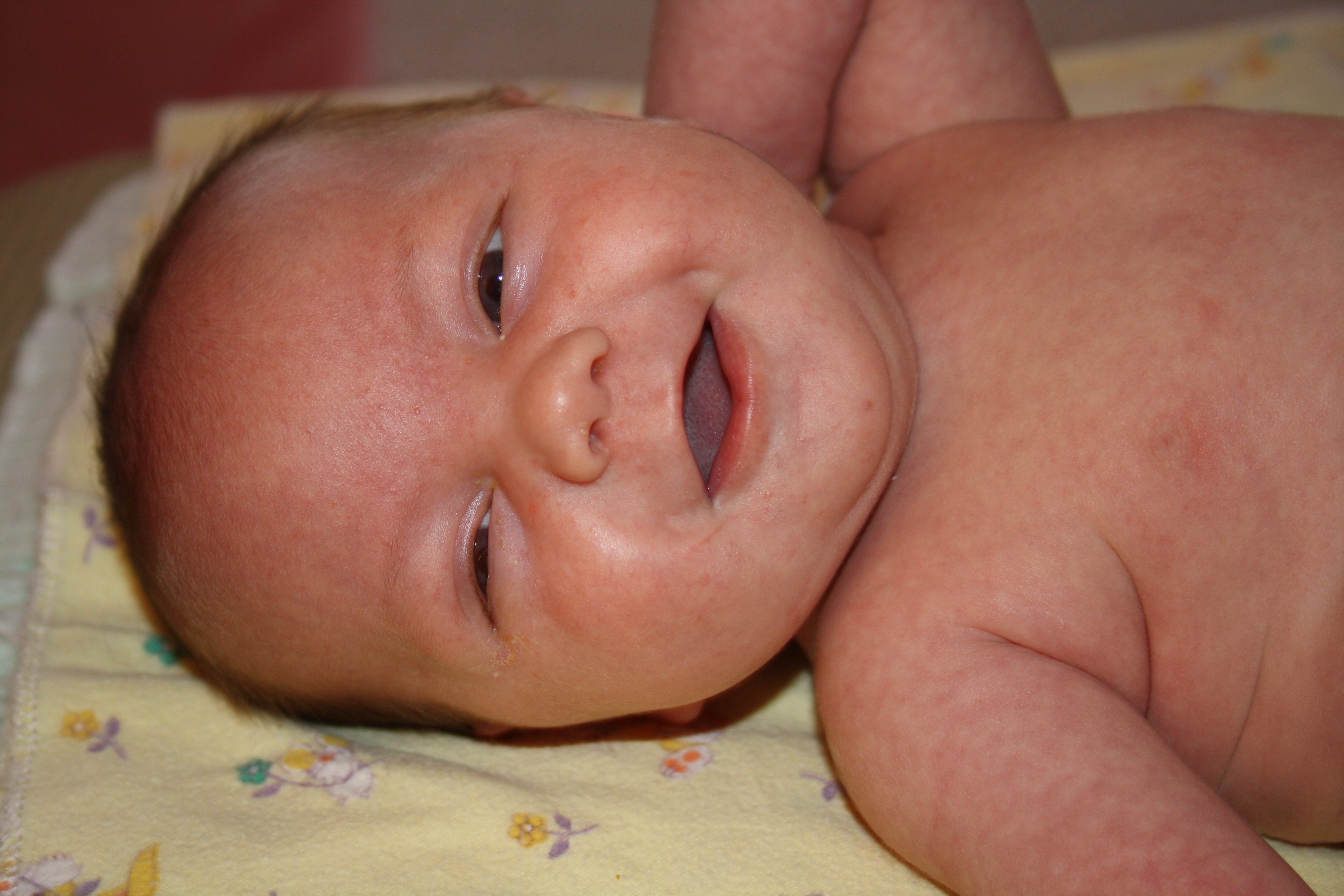 Почему у новорожденного может быть. Кандидоз у новорожденных. Белый налет на языке у грудничка. Кандидоз у новорожденных кожный.