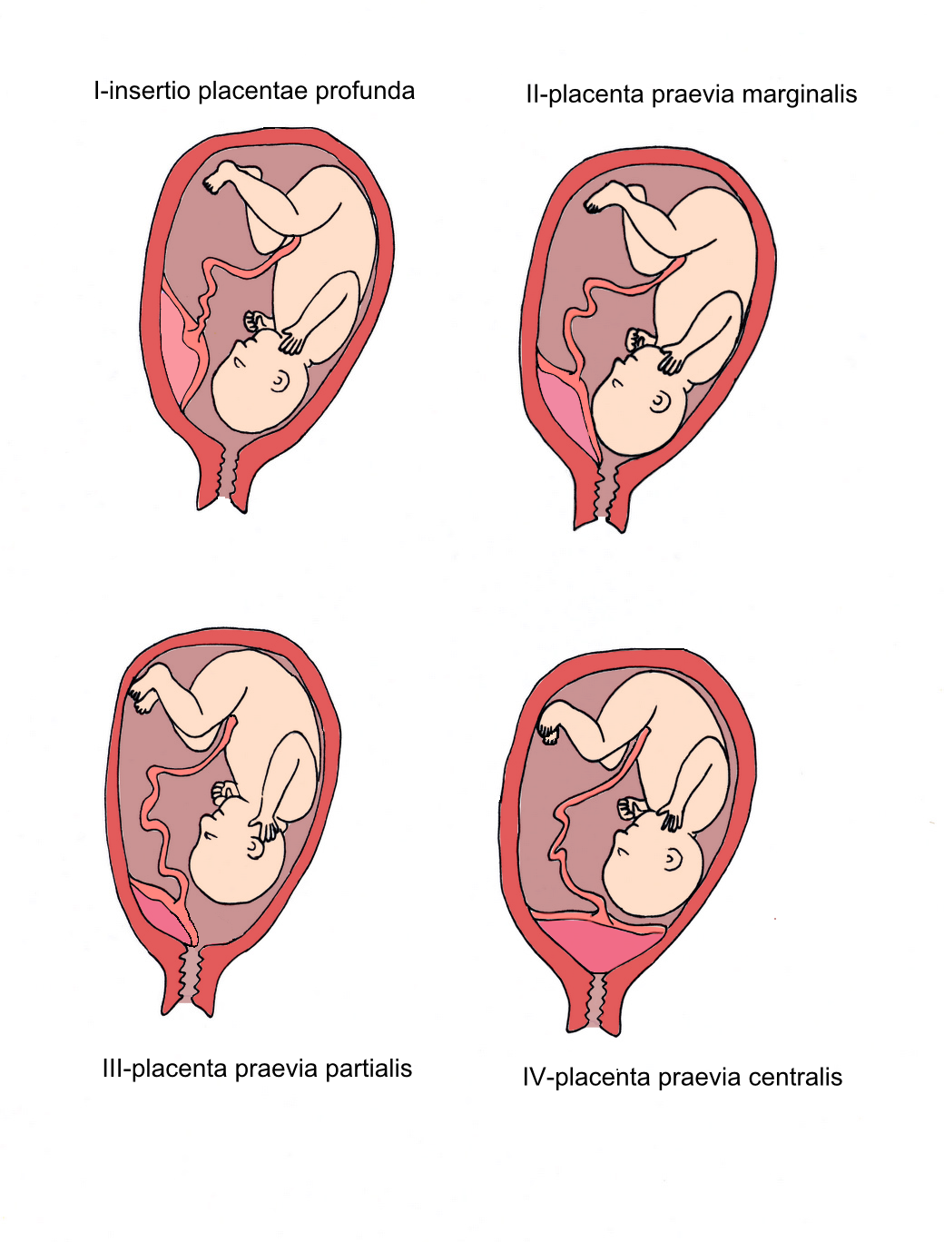 Предлежание по передней стенке. Краевое предлежание хориона. Предлежание и отслойка плаценты. Плацента краевое предлежание плаценты. Краевое и центральное предлежание плаценты.